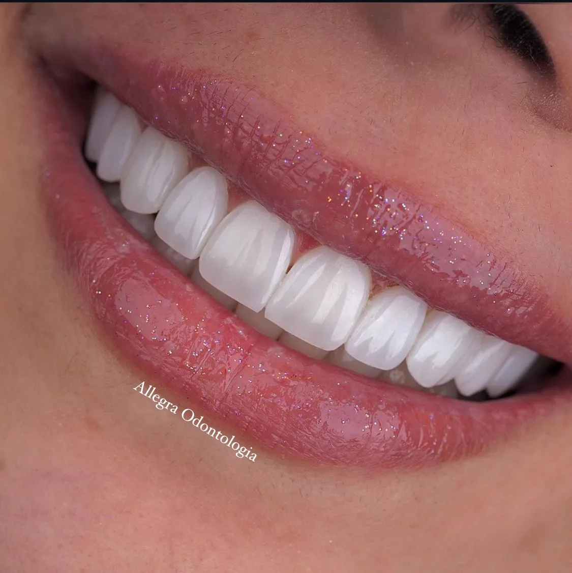 Antes e Depois - Transformação de Sorriso